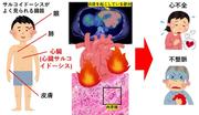 【図1】心臓サルコイドーシスでは心臓に炎症が起こり、肉芽腫を形成します。このため心臓の機能が障害を受け、心不全や不整脈を引き起こします。.jpg