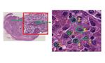 【東京医科大学】定量的核形態情報を用いた淡明細胞型腎がんの再発予測　〜従来の核異型度を超える再発予測能をもつ人工知能を応用した診断技術を開発〜