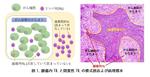 【東京医科大学】腫瘍内リンパ球は乳がん生存率と相関することを発見　～さらなる腫瘍内リンパ球の働き解明に向けて～