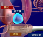 西日本初！先進医療 HIFU（ハイフ）を用いた前立腺がん局所療法を香大病院で開始