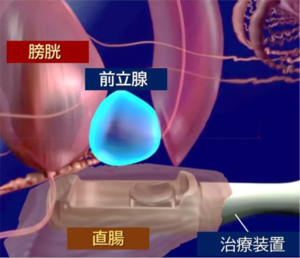 西日本初！先進医療 HIFU（ハイフ）を用いた前立腺がん局所療法を香大病院で開始