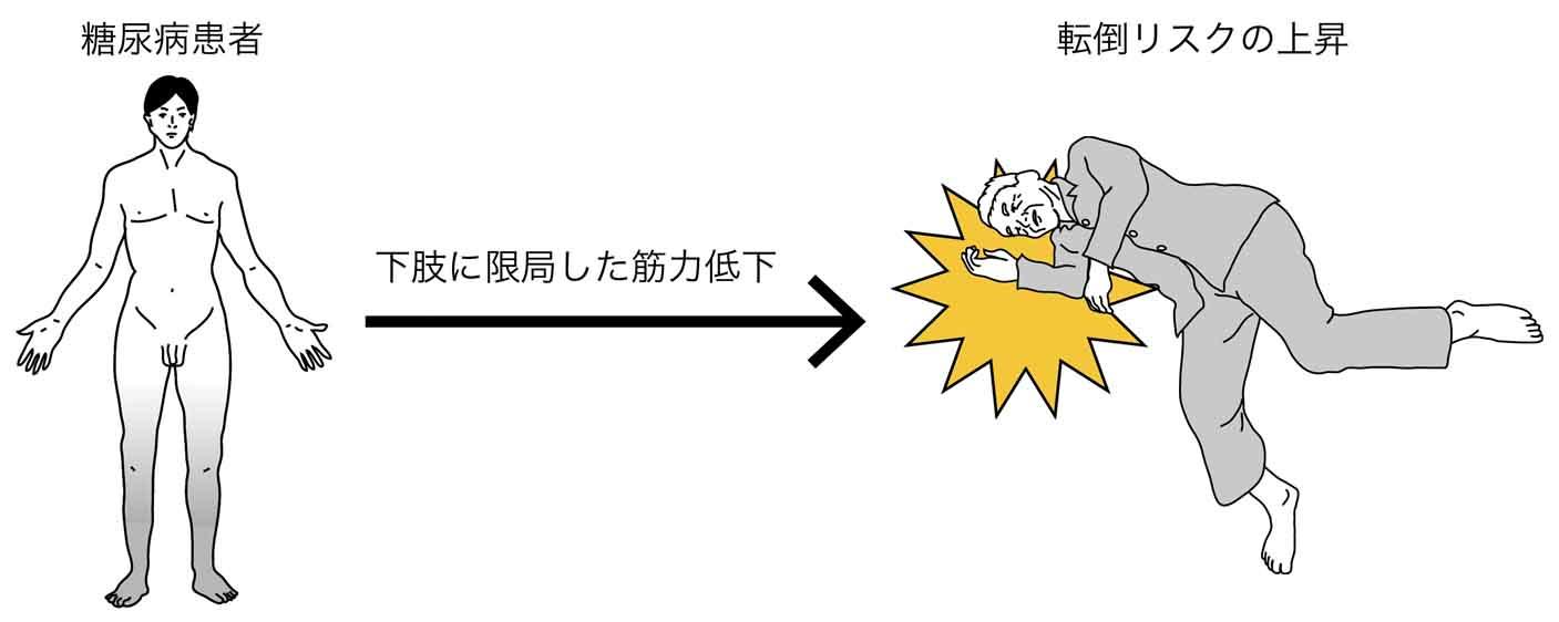 糖尿病によって脳と脊髄をつなぐ配線が破壊される!?  -- 健康科学大学の村松憲准教授らが糖尿病患者の下肢筋力低下のメカニズムを解明か