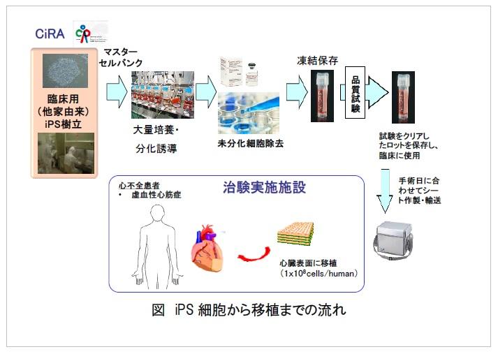 iPS細胞から作製した心筋細胞シートの医師主導治験の実施 ～重症心筋症の治療に向けて～ 大阪大学