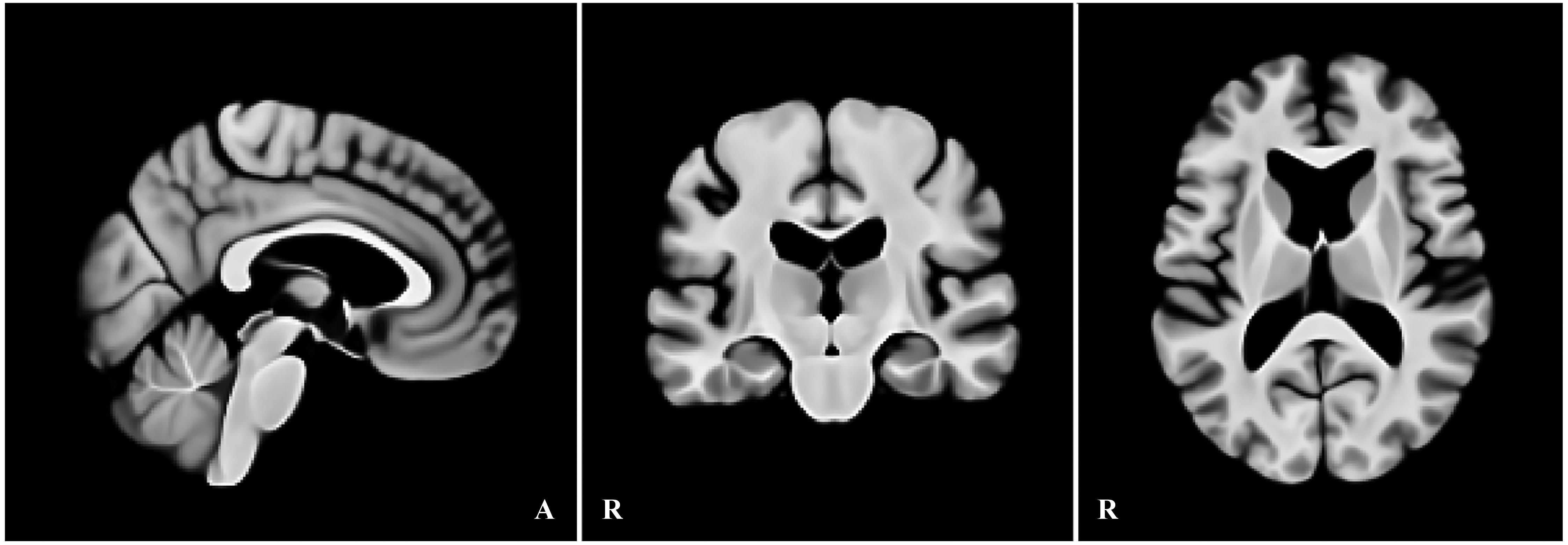 埼玉医科大学脳神経内科の大田一路らによる研究グループが新たな高齢者脳テンプレートを開発 ― 加齢に伴う脳形態の変化をより正確に反映