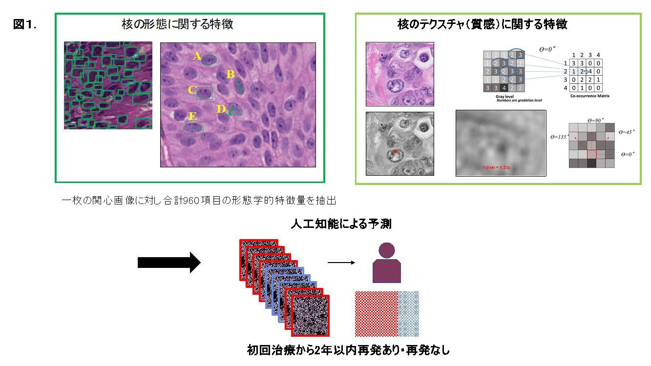 東京医科大学分子病理学分野 黒田雅彦主任教授、泌尿器科学分野 大野芳正主任教授らの研究チームが、「がん細胞核の形態学的特徴から膀胱がんの早期再発の可能性を予測できる人工知能（AI）を開発 ～今後の人工知能のシステム開発に応用が期待～」