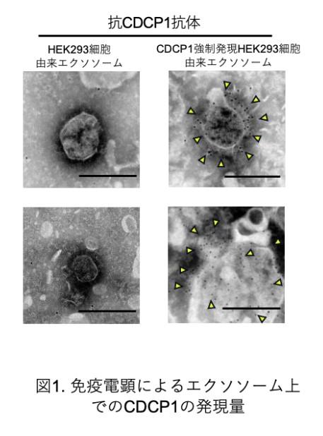 【東京医科大学】前立腺癌における新たな骨転移進展機構を解明　～ エクソソームを標的とした新たな前立腺癌治療法への期待 ～