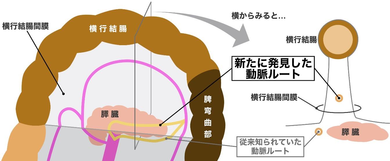 【東京医科大学】結腸脾弯曲部に向かう変異動脈の走行経路には2パターンあることを初めて明らかに～結腸脾弯曲部がんに対する膵損傷リスクの少ない新しい血管処理方法の確立に期待～（医学科生が筆頭著者）