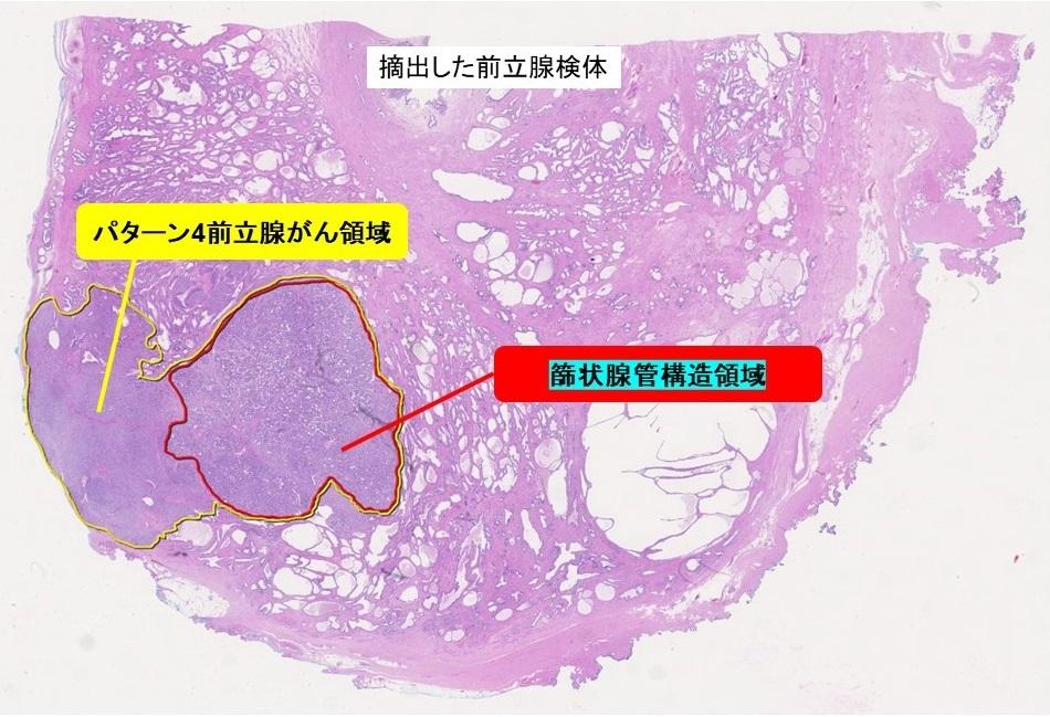 【東京医科大学】前立腺がんの篩状腺管構造と再発との関連 ～前立腺がんの悪性度分類の改訂の際に重要な知見を報告～