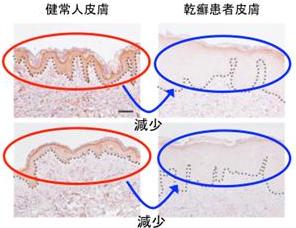 東京薬科大学が、皮膚の脂質代謝が乾癬様皮膚炎と全身の炎症に関与することを発見――乾癬の新たな治療法開発に期待