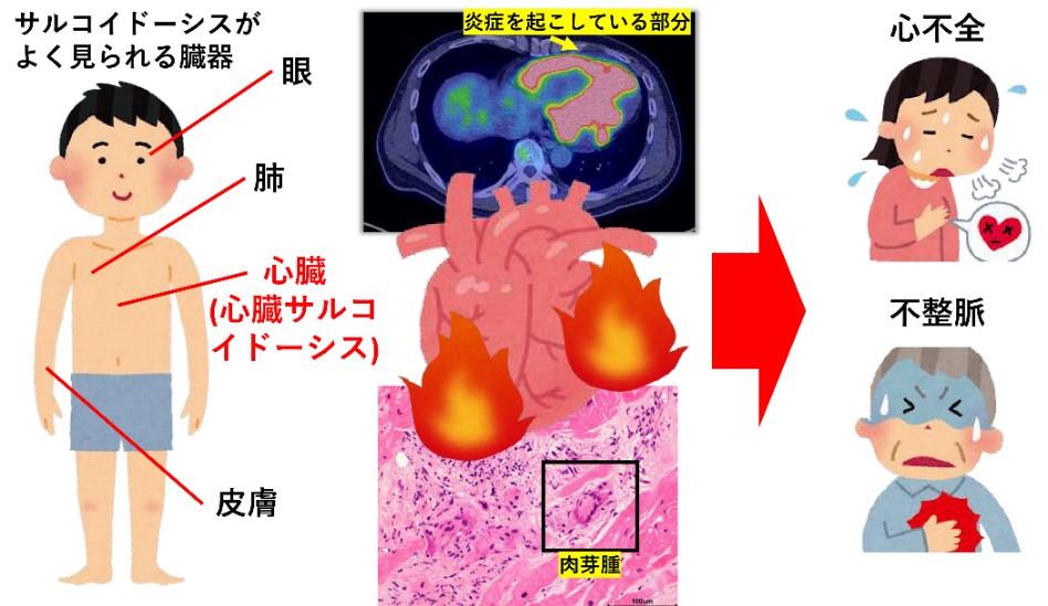 心臓サルコイドーシスの心イベント関連因子が明らかに ～世界最大の国内多施設レジストリからの報告 -- 北里大学