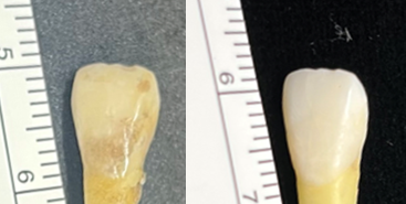 エナメル質を治しながら歯を白くする審美修復技術を開発　アレルギー反応を起こさない、安全な治療法として期待