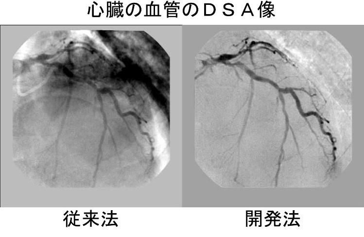 動く臓器の血管像をより鮮明に AI活用のX線画像処理技術に特許 -- 広島国際大学