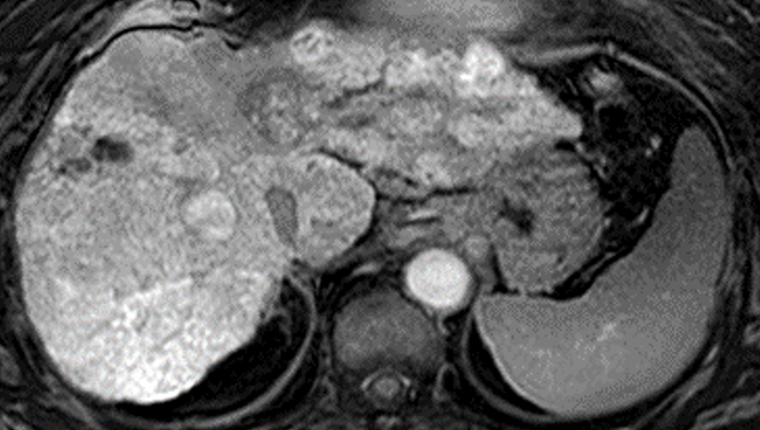 肝細胞がん免疫療法の効果を予測する画像バイオマーカーを発見　免疫療法の効果がない患者に対するMRI診断の有効性を証明