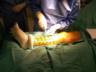 【東京医科大学】先進医療で実施中の「自己骨髄由来培養間葉系細胞移植による末梢動脈疾患に対する完全自家血管新生治療法」の安全性に関する論文が掲載　～虚血による下肢切断の回避、疼痛軽減を目指して～