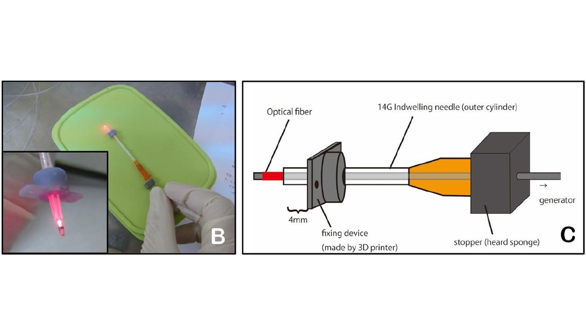 【東京医科大学】悪性神経膠腫に対する組織内光線力学的療法(i-PDT)の実用化に向けた基礎実験において有用性を確認　～悪性脳腫瘍に対する新規治療法の開発に期待～