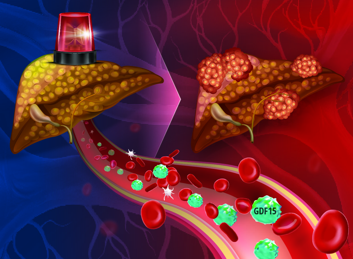 【大阪大学】”脂肪肝から肝がんになりやすい人”を見分ける新指標 ― 肝がんの早期発見・早期治療へ期待
