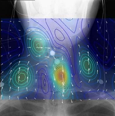 東京医科歯科大学医学部附属病院が非侵襲で生体の神経活動を可視化する脊髄磁界計測システムを用いた腰部、頚部、末梢神経の生体磁界計測に成功 — 東京医科歯科大学、金沢工業大学、リコーでのオープンイノベーションで製品化を目指す —