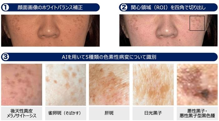 AIを用いた顔のシミの高精度診断支援システム開発に成功　レーザー治療実施判断を支援し、治療の最適化に期待
