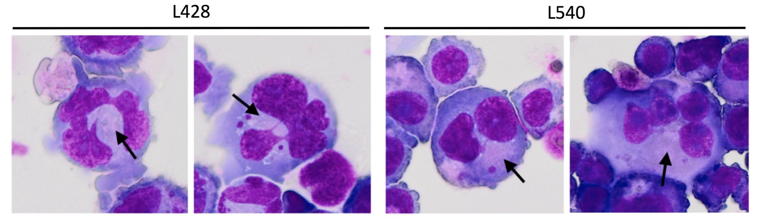 CD30は古典的ホジキンリンパ腫においてリード・シュテルンベルグ細胞と複雑な染色体異常の形成に関与する–北里大学