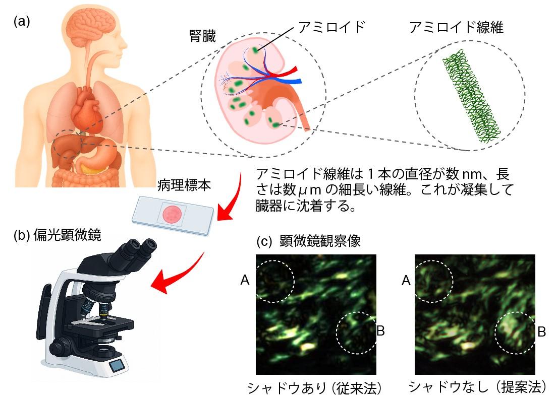 【埼玉医科大学・宇都宮大学】「影のない画像」でアミロイドーシスを鮮明に診断！ ～ 新技術で複屈折を定量化、従来法を超える画像を実現