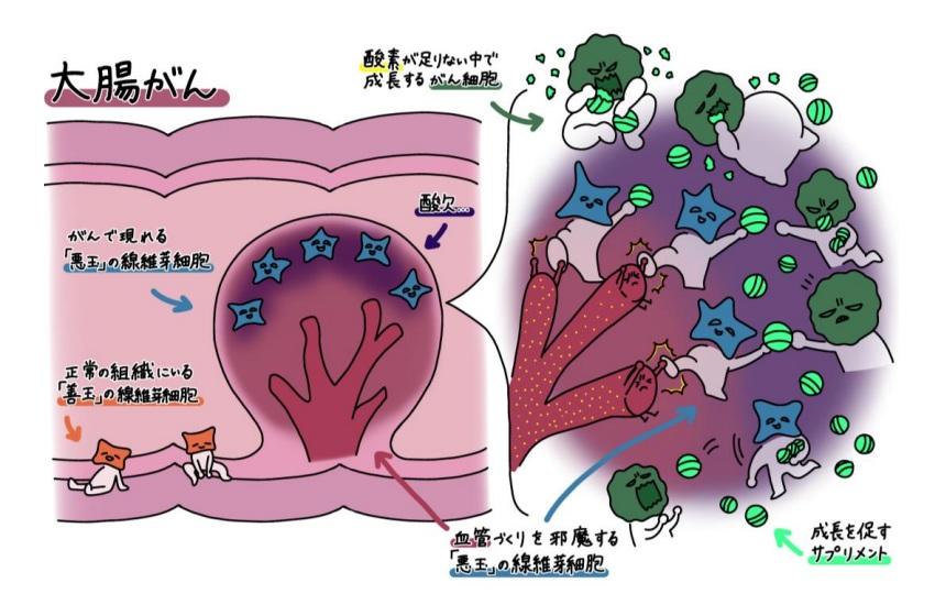 【大阪大学】部分的な酸欠状態が、大腸がんを悪性化させる ― 酸素不足はがんにとってむしろ好都合!?