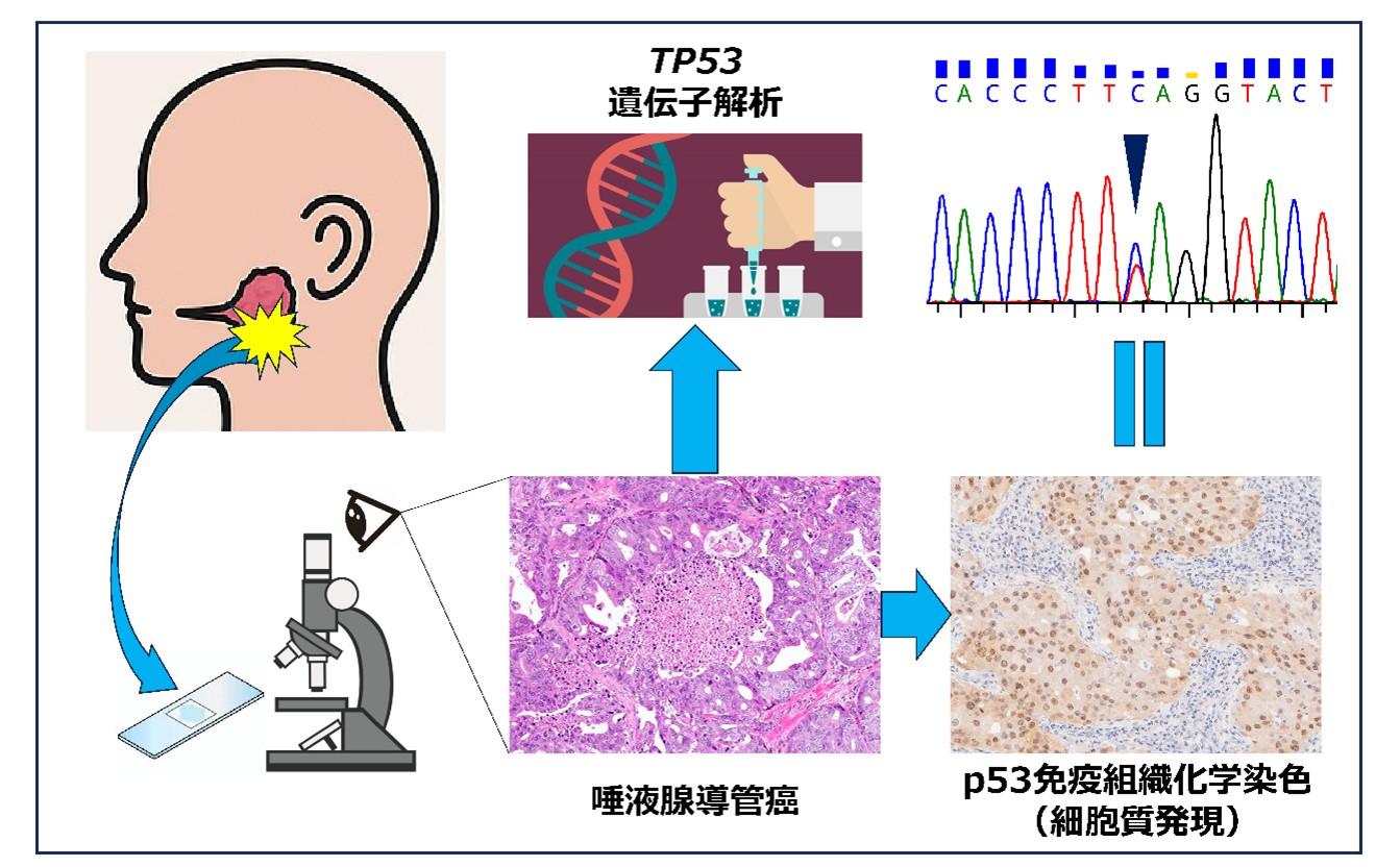 【東京医科大学】高悪性度唾液腺癌の予後因子となる新規のがん抑制遺伝子発現様式を発見 ～多施設共同研究によるp53タンパク細胞質発現パターンとTP53遺伝子変異の相関を解明～