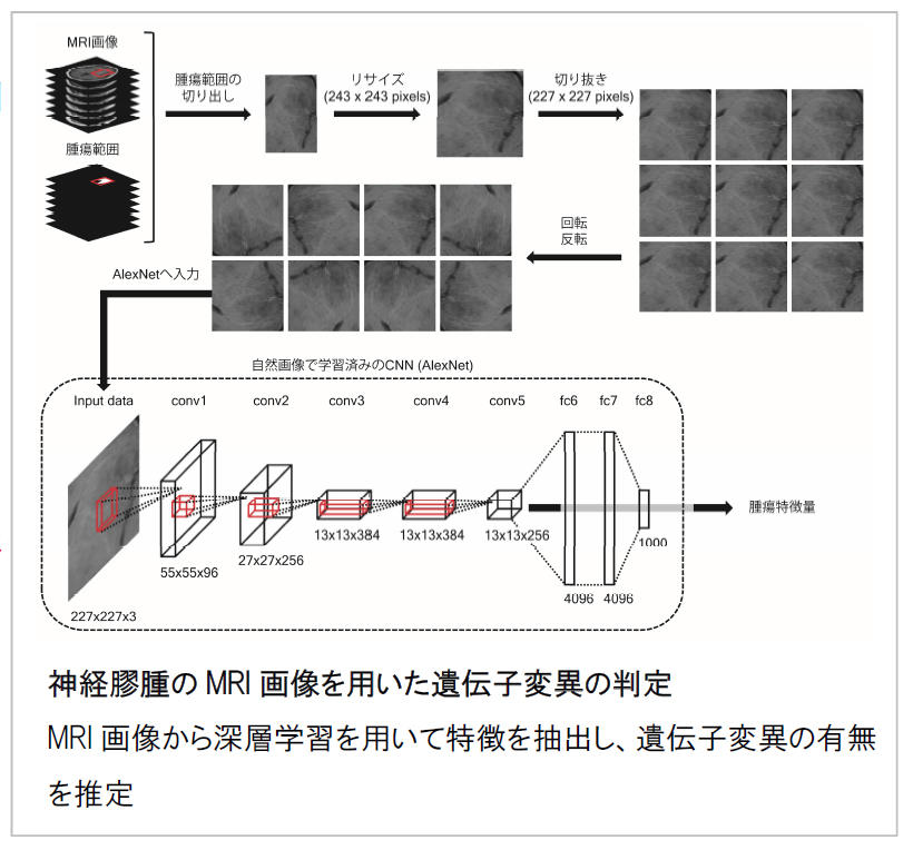 脳のMRI画像だけから脳腫瘍の遺伝子変異を推定するAI技術を開発 — 大阪大学