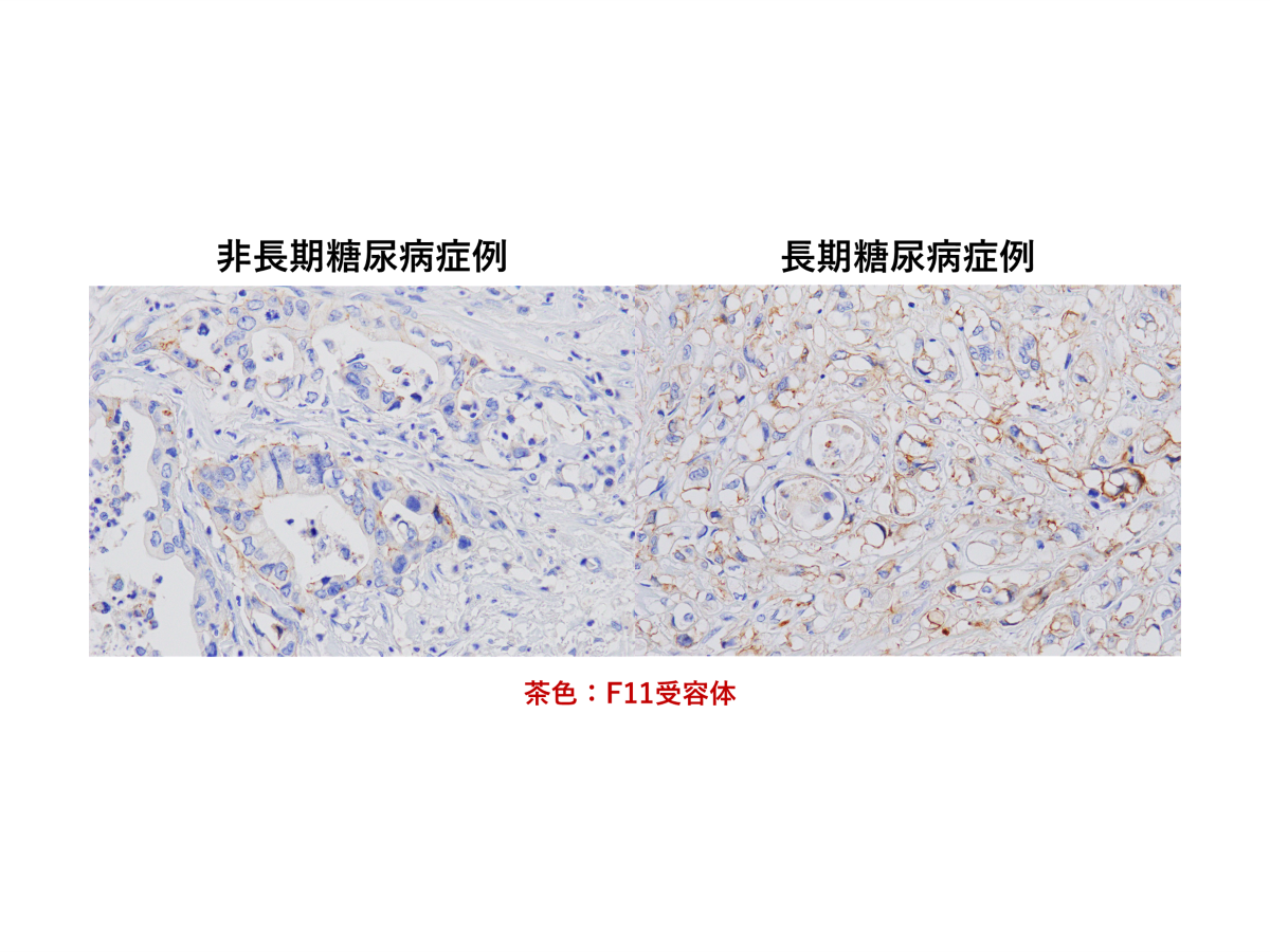 弘前大学の水上浩哉教授らの研究グループが長期糖尿病合併膵導管がんの新規発症機序を解明 ― MEG3、F11Rを標的とした新たな治療法の確立に期待