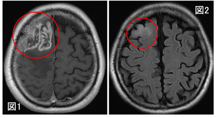 膠芽腫の画像起源の解明～いつから腫瘍は存在していたのか？～（北里大学）